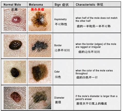 手臂上的痣|有这5种“痣”要小心，可能会恶变